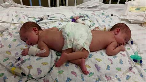 Risky surgery separates 10-month-old from parasitic twin - CNN