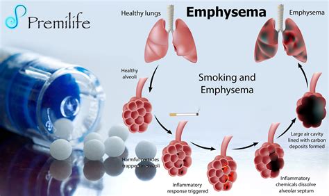 Emphysema Infographic