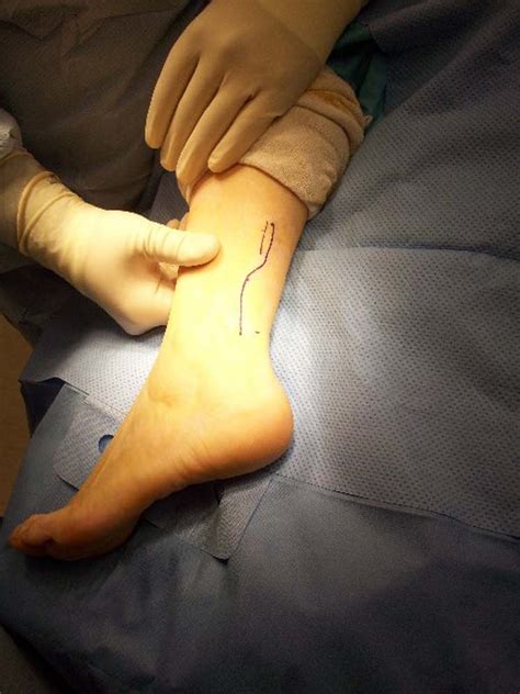 Ganglion Cyst | The Foot and Ankle Online Journal