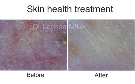 Demodex skin infection - Vista Clinic Australia