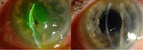 Corneal Perforation | Semantic Scholar