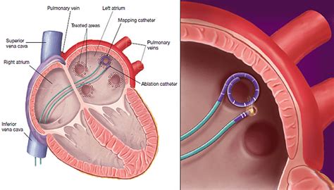 Ablation for Atrial Fibrillation - Advanced Heart and Vein