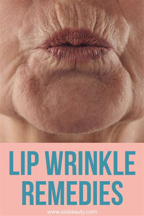 The 6 Best Upper Lip Wrinkle Treatments