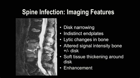 Mri Cervical Spine Anatomy