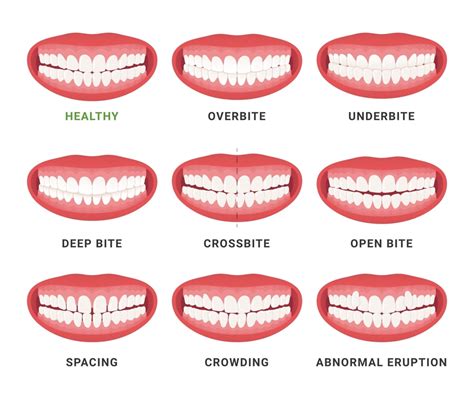 Overbite vs Normal Bite: Differences, Causes, and Treatment