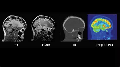 New database of healthy adult human brain PET, MRI and CT images is now ...