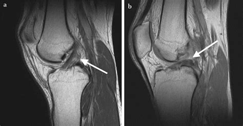 Mri Scan Knee Ligament Damage