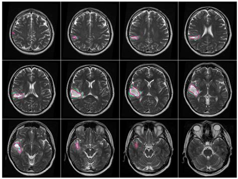 Brain Mri Scan Tumor