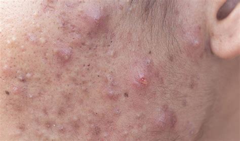 Cystic Acne - Causes And Best Treatment Options