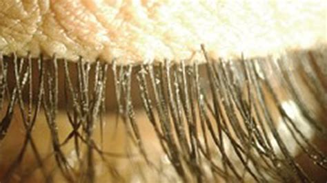 Demodex Mites Hair Loss - The Relation Between Alopecia And Demodex ...