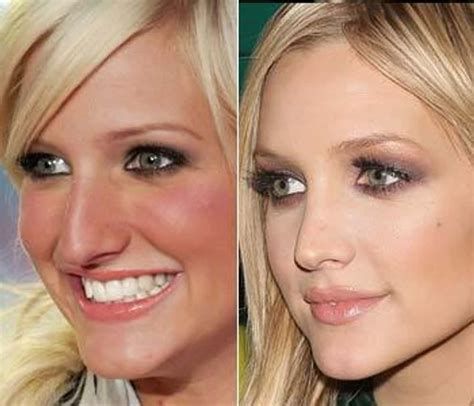 Celebrity Nose Jobs: Before and After