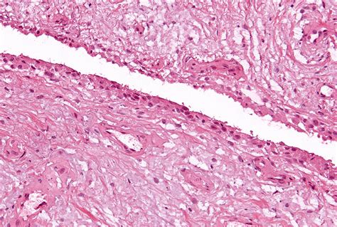 Pathology & Laboratory Medicine: Synovial Lining Hyperplasia