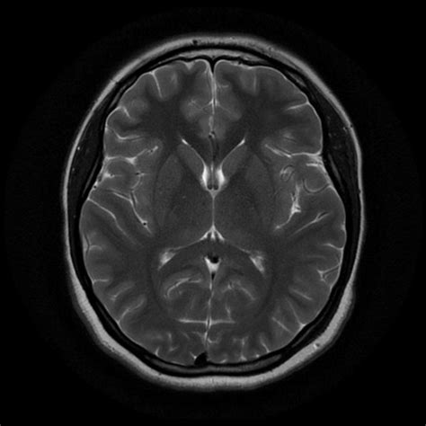 12 Normal brain mri images ideas | mri, mri brain, brain