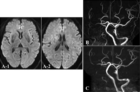 Magnetic resonance imaging (MRI) and MR angiography (MRA) findings. (A ...