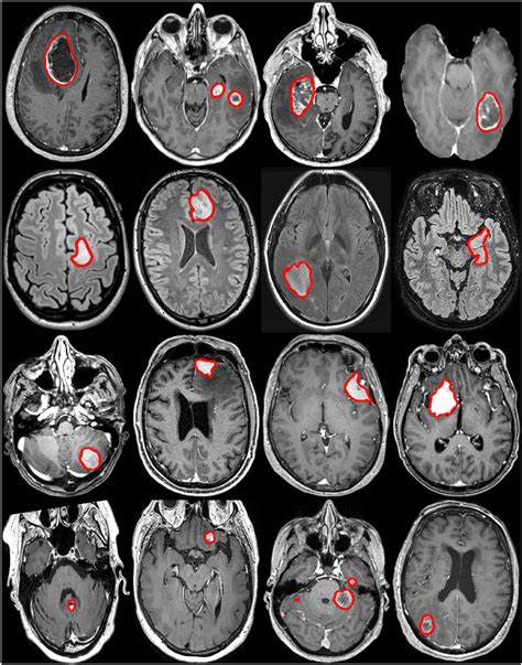 Brain Tumor Color Mri