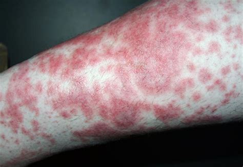 Diabetic skin rash pictures | Symptoms and pictures