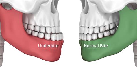 Underbite