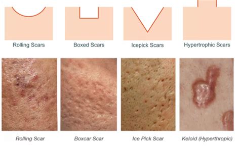 Acne Scars - PREMIER DERM MD | TREATING ACNE & SCARRING, WRINKLES, DARK ...