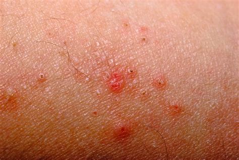 diabetic dermatitis - pictures, photos