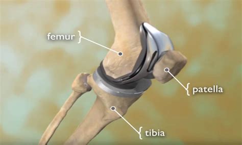 Total Knee Replacement Animation - OrthoInfo - AAOS