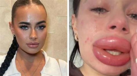 Influencer warns followers not to accept free fillers after her lips ...