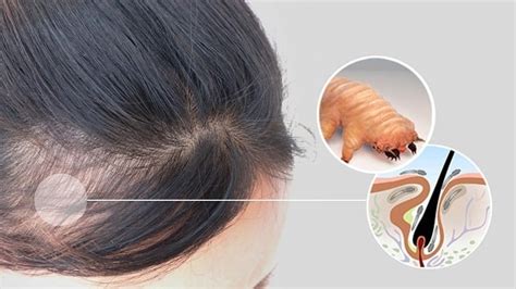 The Relation Between Alopecia and Demodex Mites | Ungex