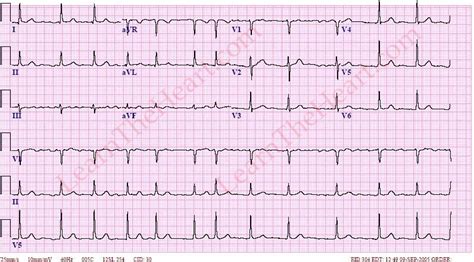 Atrial Fibrillation with normal Ventricular Rate (Example 3 ...