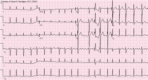 AFib vs AFlutter – ECG Quiz