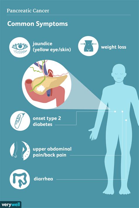 Pancreatic Cancer: Signs, Symptoms, and Complications