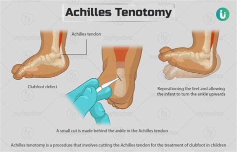 Achilles tenotomy: Procedure, Purpose, Results, Cost, Price ...