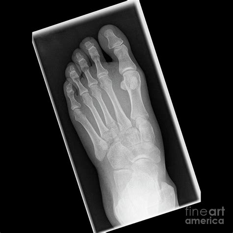 Metatarsal Fracture Left Foot