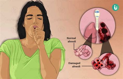 Emphysema symptoms, causes, treatment, medicine, prevention, diagnosis