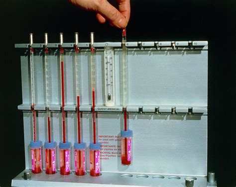 Measurement Of Esr Of Blood Photograph by Science Photo Library. - Pixels