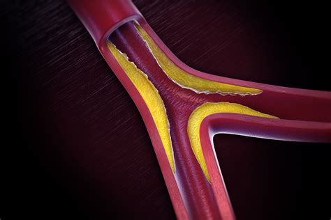 Overview of Peripheral Artery Disease