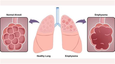 What Are The Symptoms of Emphysema? – Entirely Health