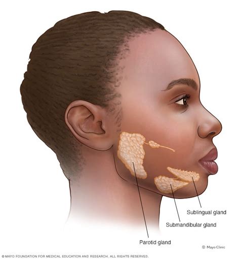 Mumps - Symptoms and causes (2023)