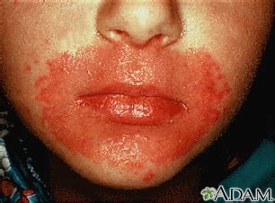 Candida infection of the skin Information | Mount Sinai - New York