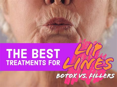 The Best Treatments For Lip Lines – Botox vs. Fillers - Dr. Carolyn Mai ...