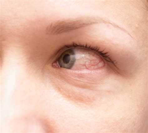 Allergic conjunctivitis: Treatment, symptoms, and causes (2022)