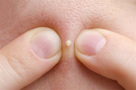 The Scientific Reason People Love Pimple-Popping Videos | Live Science