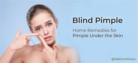 Blind Pimple: 8 Home Remedies for Pimple Under the Skin