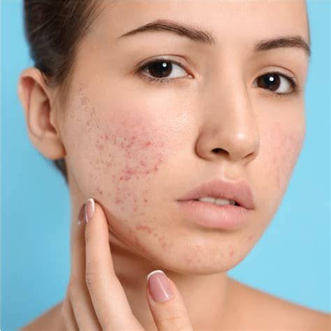 Acne Scar Subcision | Benefits of Subscision for Scars