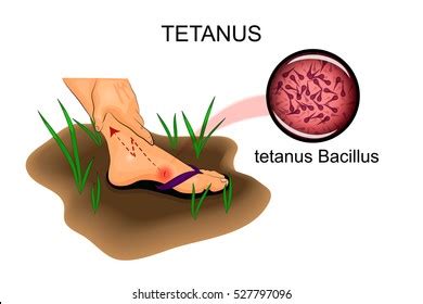 5,975 Tetanus Images, Stock Photos & Vectors | Shutterstock