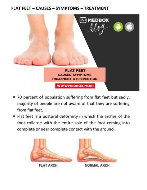 Flat feet – causes – symptoms – treatment