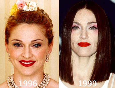 Madonna Plastic Surgery Before and After Photos