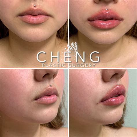 Lip Filler Before & After | Lip fillers, Lips, Juvederm lips