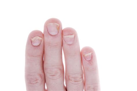 Nail psoriasis and psoriatic arthritis symptoms connected