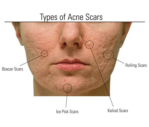 26+ Chin Acne Scars Images - Acne problems