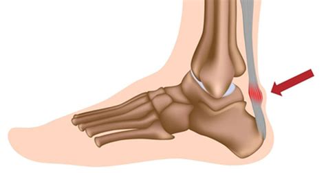 Achilles Tendonitis | Diagnosis, Treatment & Rehabilitation Exercises