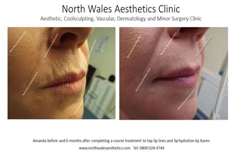 What Causes Vertical Lines On Upper Lip | Sitelip.org